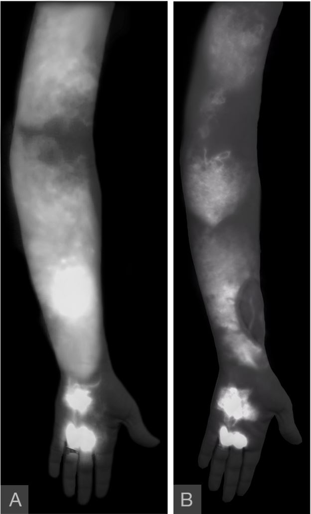 Vascularized Lymph Vessel Transfer for Extremity Lymphedema Is